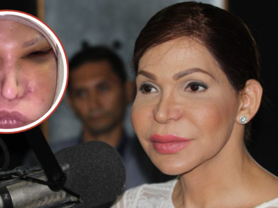 Mía Cepeda revela cirugía de 12 horas para retirar polímeros de su rostro